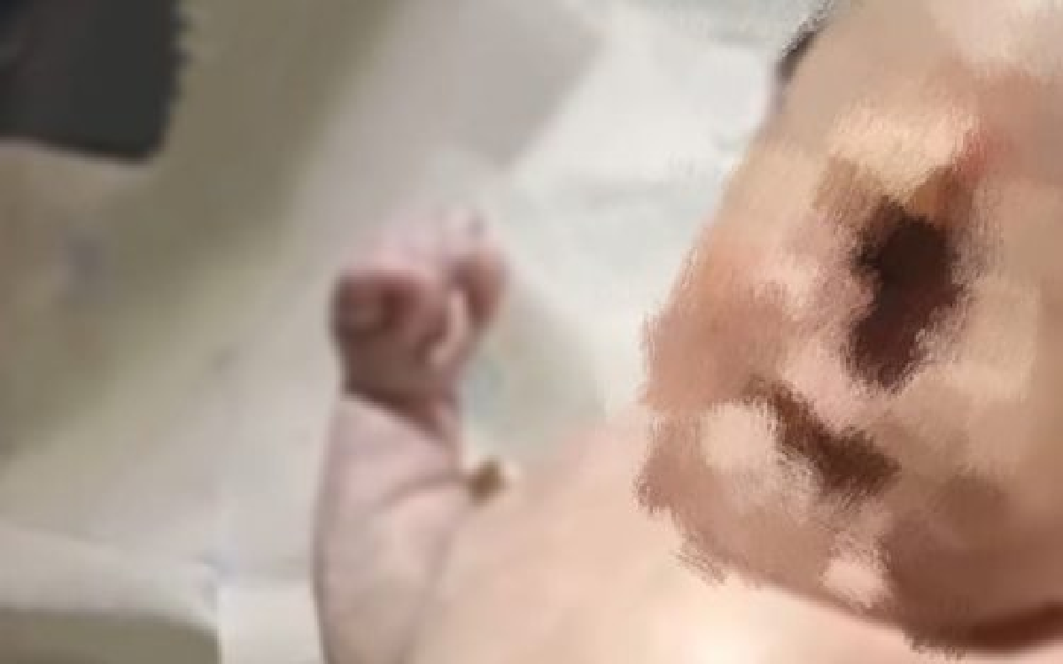 VIRAL! Seorang Bayi Lahir Bermata Satu di Muba Sumatera Selatan, Kok Bisa?