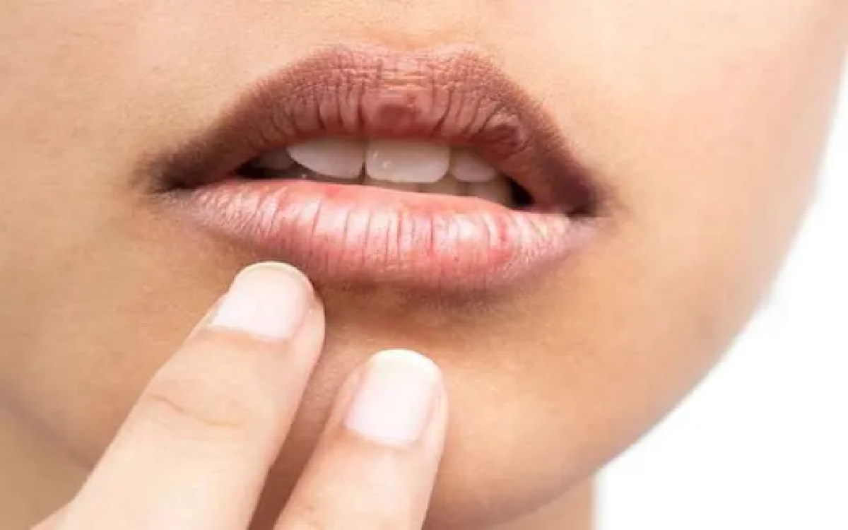 5 Penyebab Bibir Menjadi Hitam, Bukan Cuma Gara-gara Rokok!