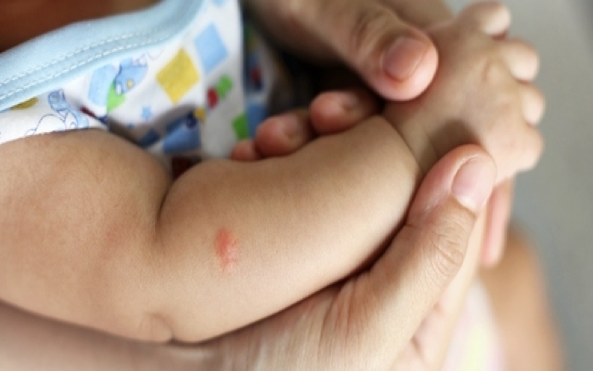 6 Cara Menghilangkan Bekas Gigitan Nyamuk Pada Kulit Bayi