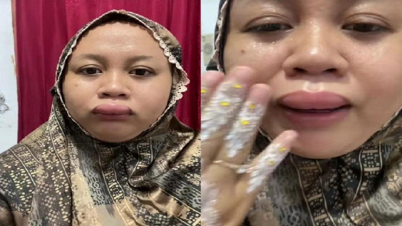 Ada-ada Saja! Pengantin Ini Viral Gegara Bibirnya Jontor 3 Jam Sebelum Akad