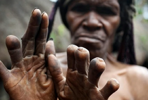 Mengenal Lebih Dekat Tradisi Potong Jari di Papua: Ini Makna dan Nilai Budaya Tersembunyinya