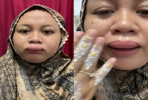 Ada-ada Saja! Pengantin Ini Viral Gegara Bibirnya Jontor 3 Jam Sebelum Akad