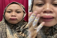 Ada-ada Saja! Pengantin Ini Viral Gegara Bibirnya Jontor 3 Jam Sebelum Akad