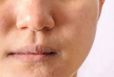 Peeling Face Skin Treatment: 5 Safe Ways to Heal Sore, Flaky Facial Skin Fast Naturally